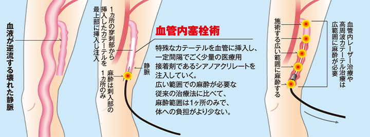 グルー治療